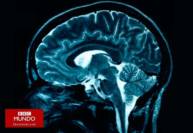 La mutación que puede proteger contra el Alzheimer
