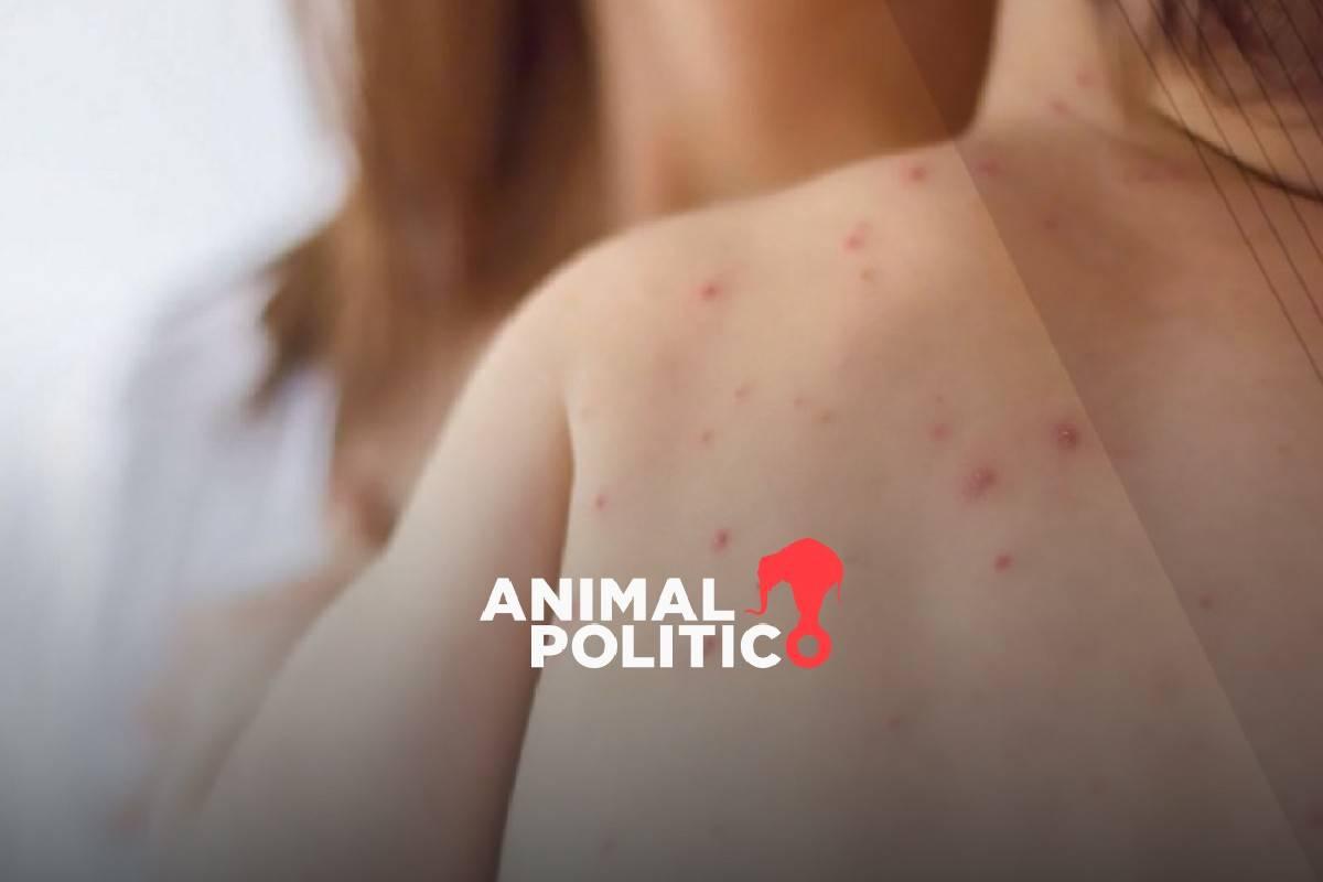 Brote de sarampión está confirmado en todos los estados; suman 7 mil 131 casos