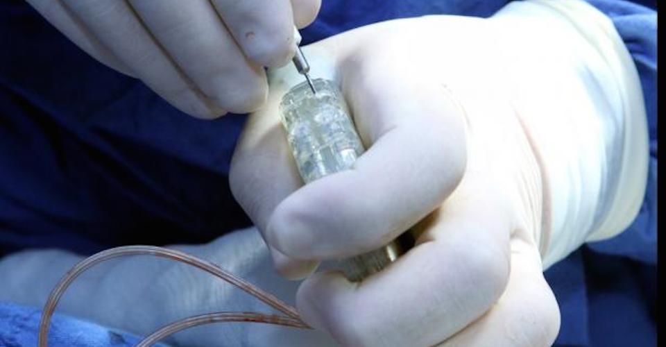 Gobierno busca comprar marcapasos a 90 pesos cuando su precio es de 23 mil