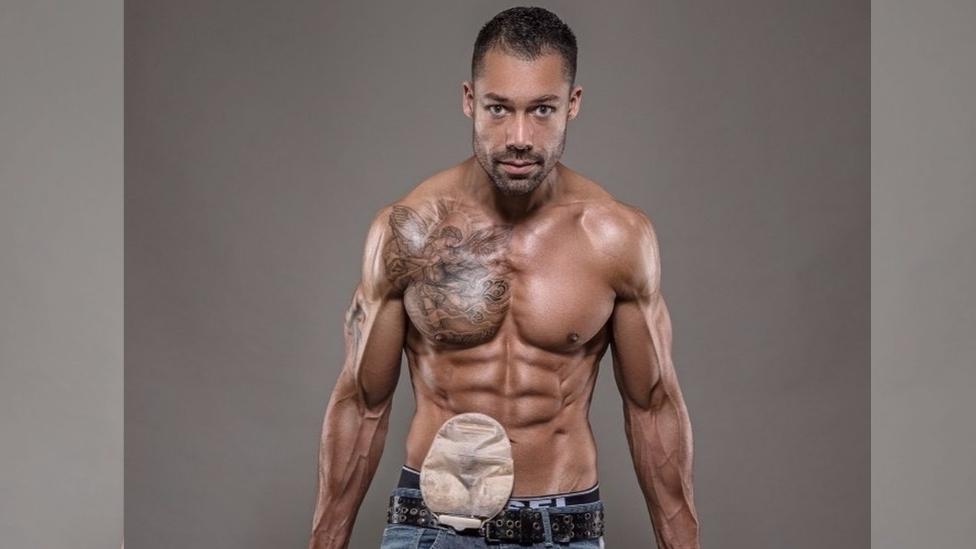 Recto fantasma: 3 testimonios sin tapujos sobre cómo es vivir con una bolsa de colostomía