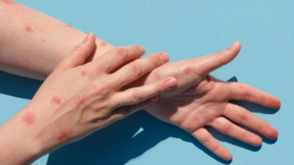 Viruela del mono llega a Puebla; Barbosa confirma dos casos