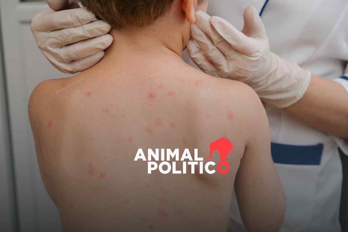 México registra 24 muertes por sarampión en 2025; Chihuahua, el estado con más registro de defunciónes